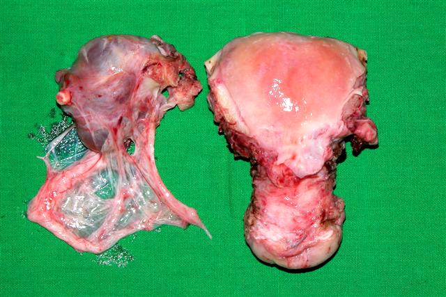 Uterus with right tubo-ovarian mass and adhesions